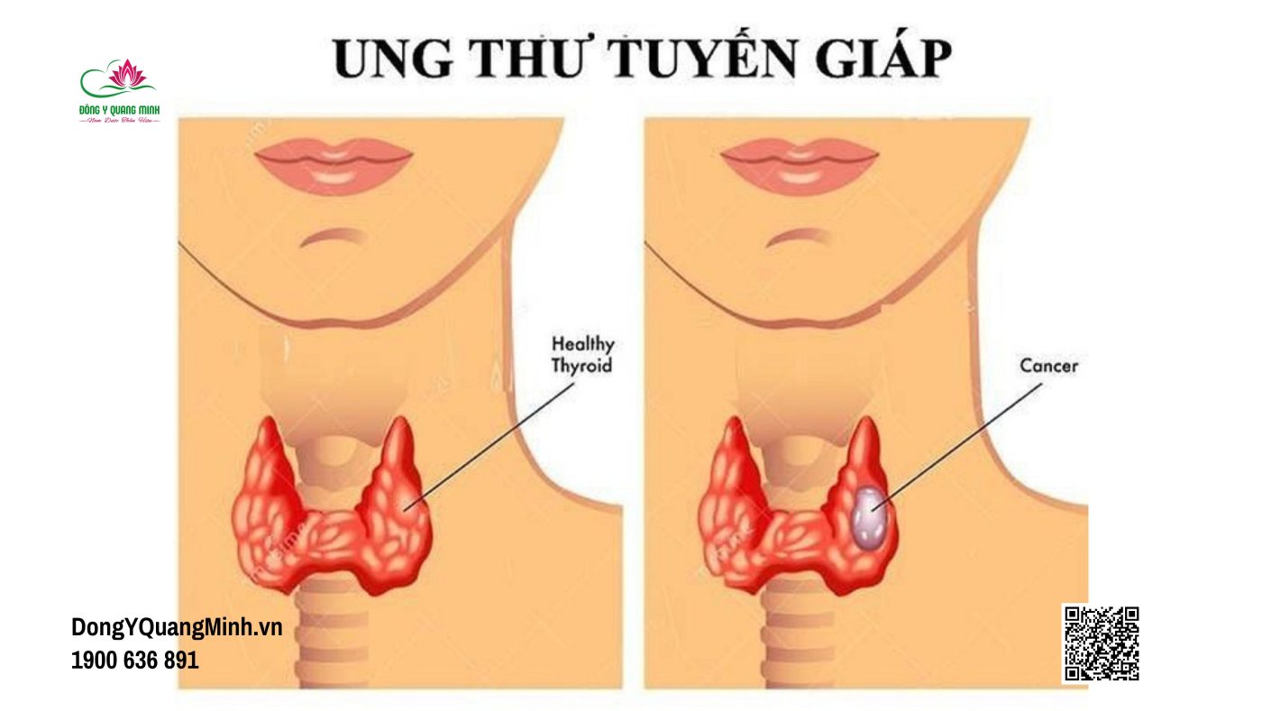 những bệnh lý tuyến giáp