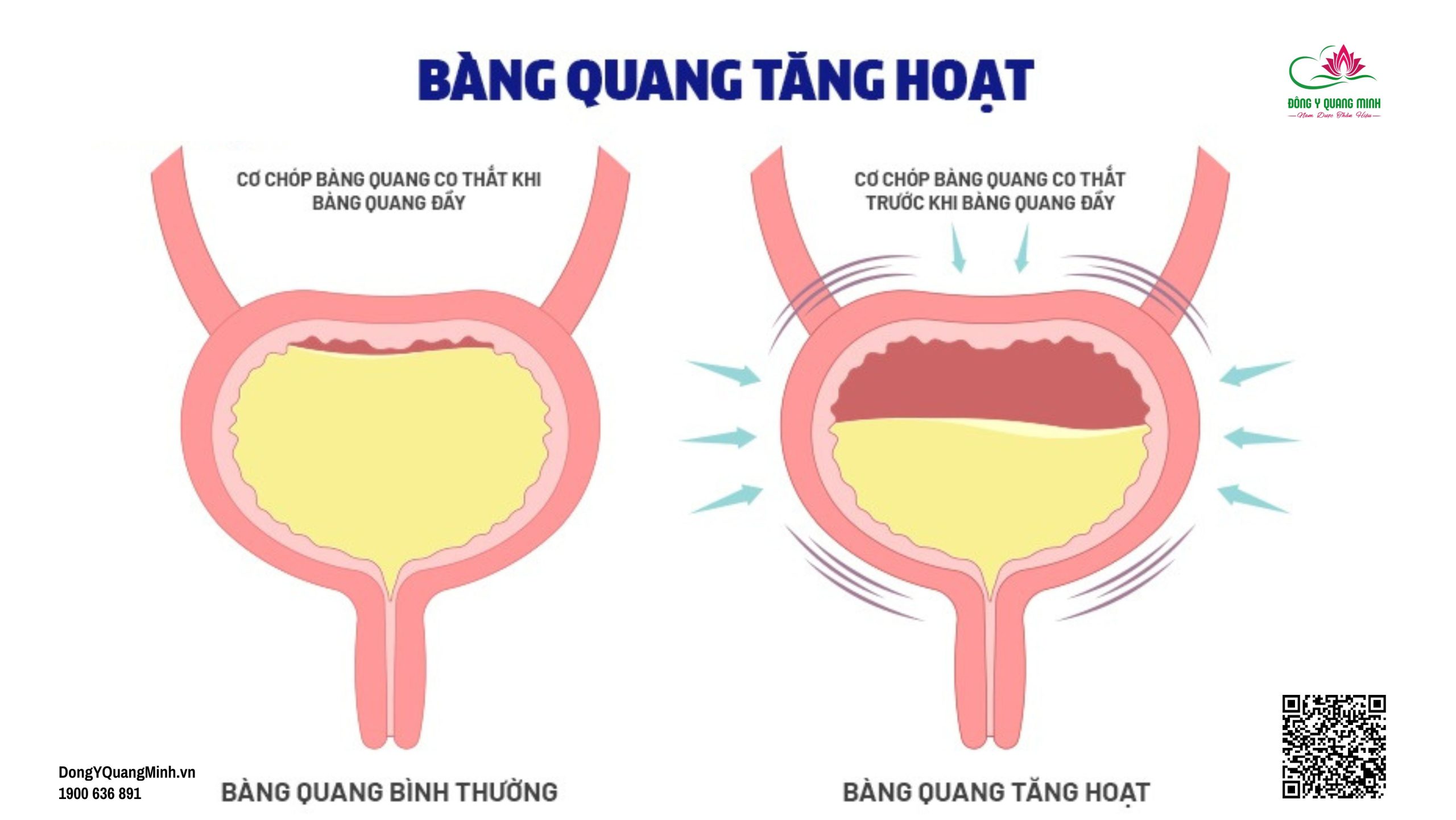 bàng quang tăng hoạt