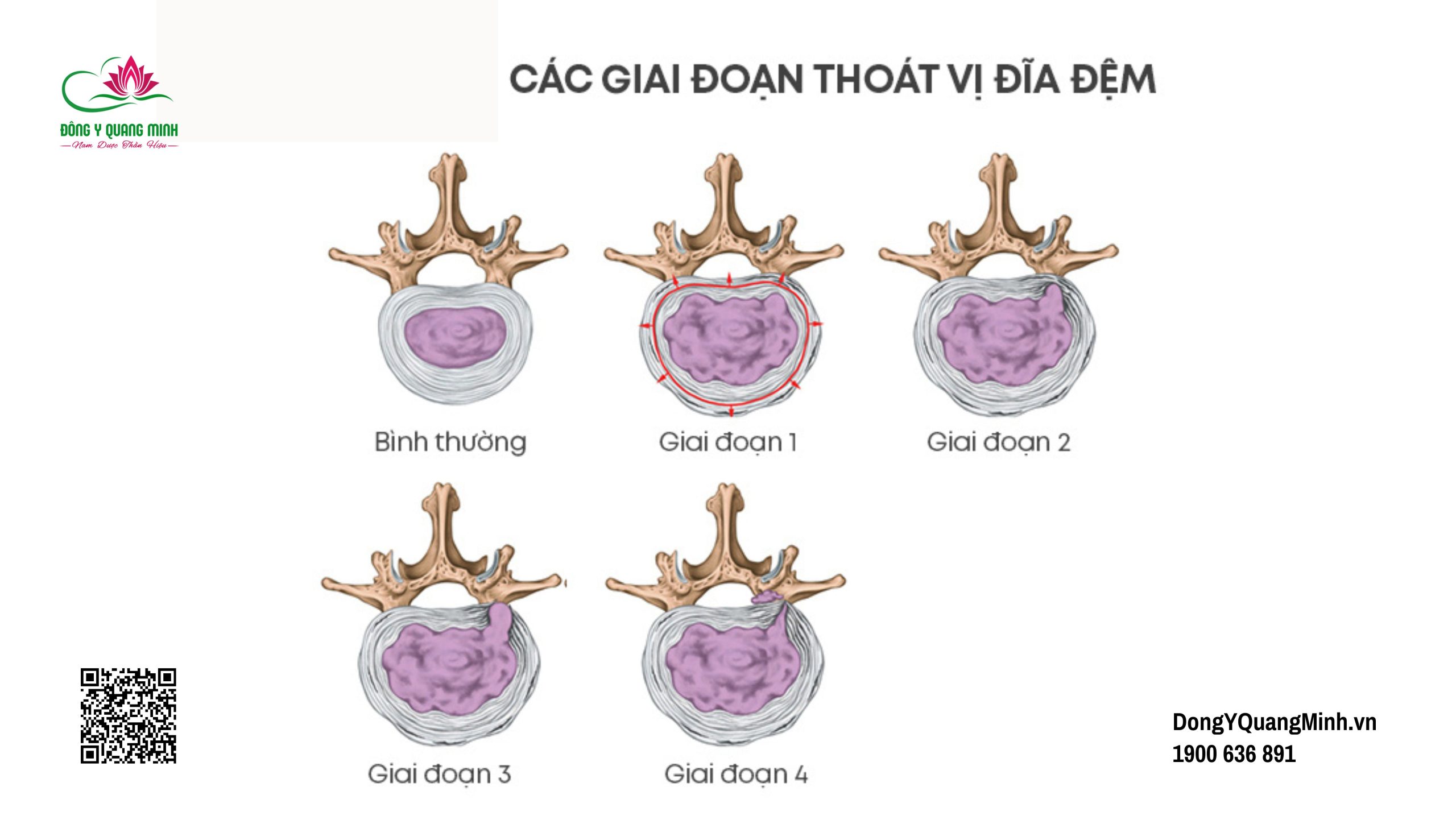thoát vị đĩa đệm lưng
