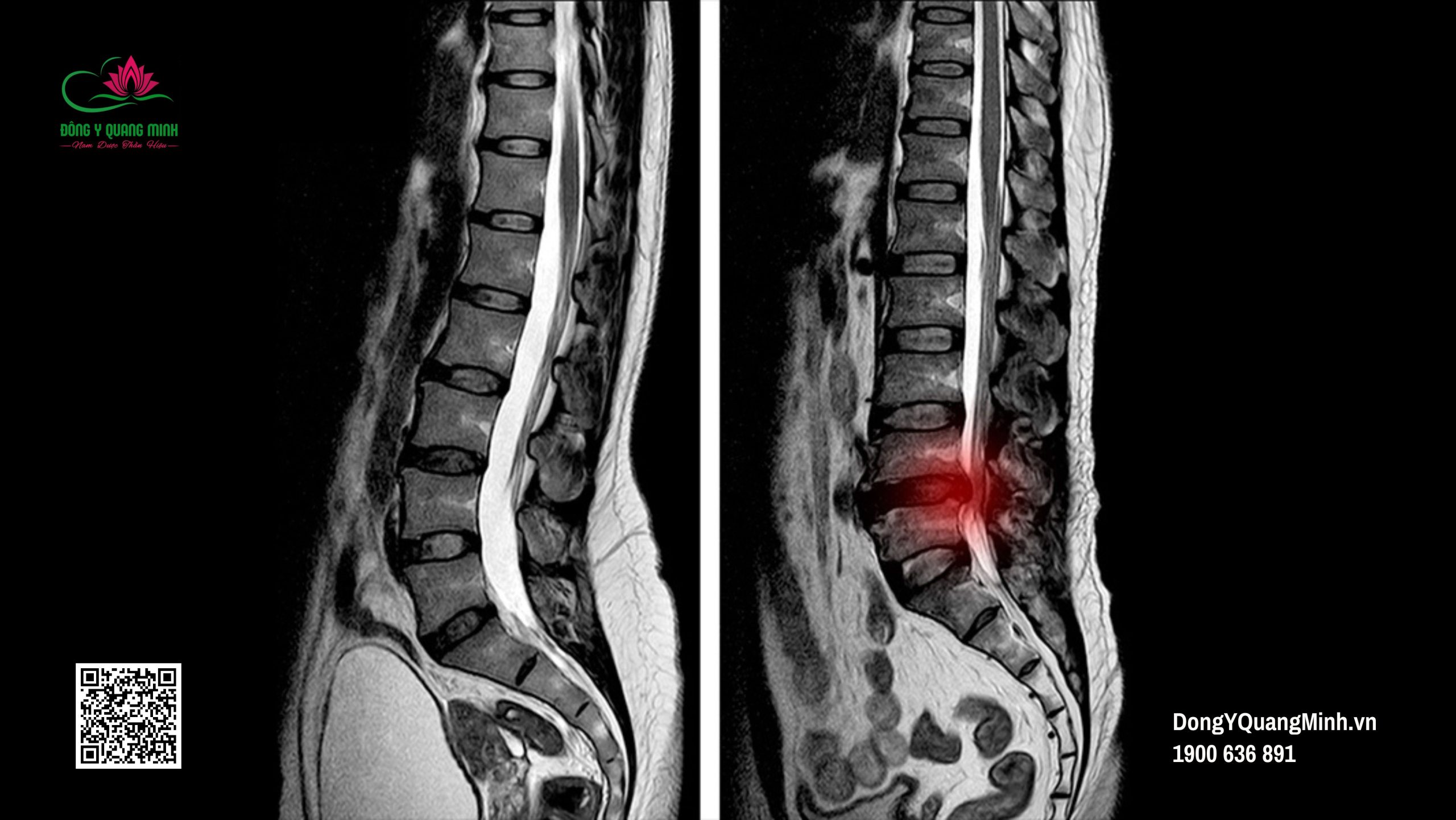 thoát vị đĩa đệm lưng