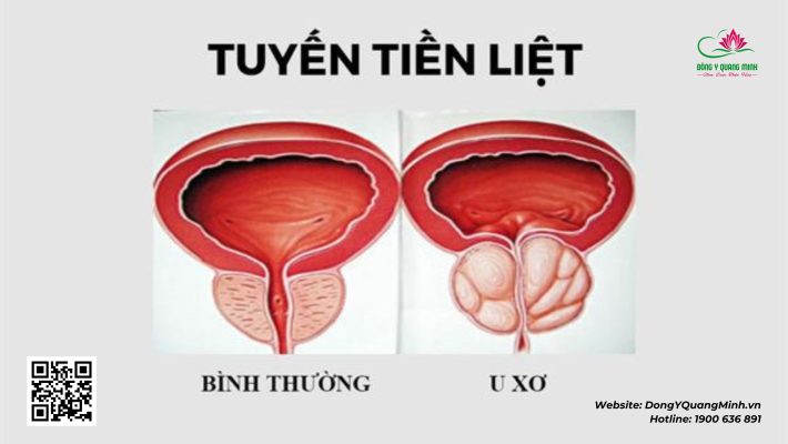 siêu âm tuyến tiền liệt