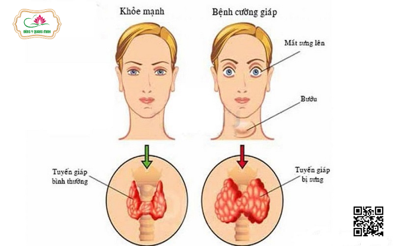 Tuyến Giáp Là Gì Và Quan Trọng Như Thế Nào Đối Với Cơ Thể?