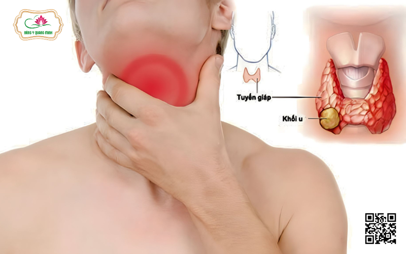 Ung thư tuyến giáp