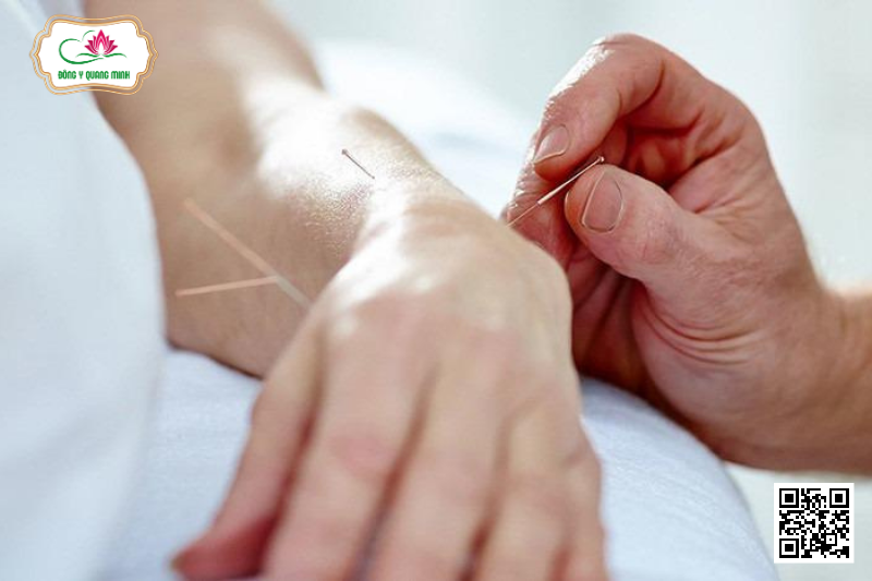 châm cứu