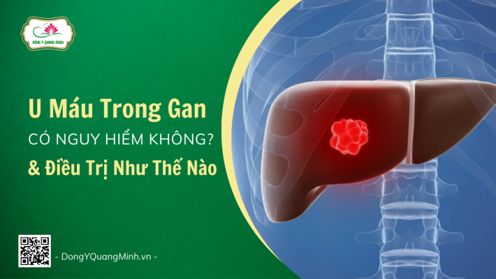 U Máu Trong Gan Là Gì? Có Nguy Hiểm Không?