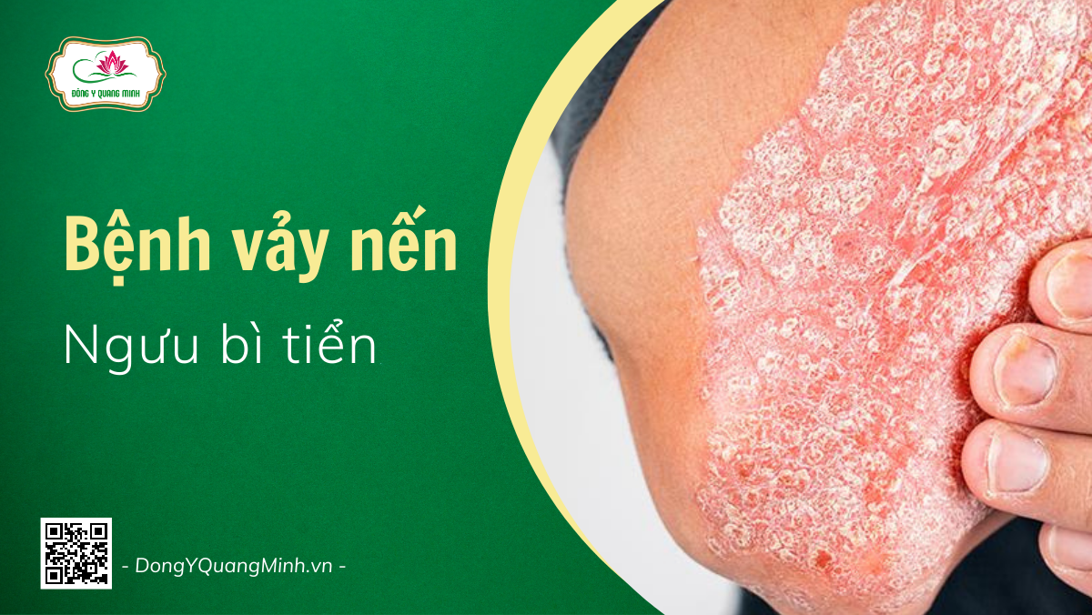 Bệnh Vảy Nến | Ngưu Bì Tiển