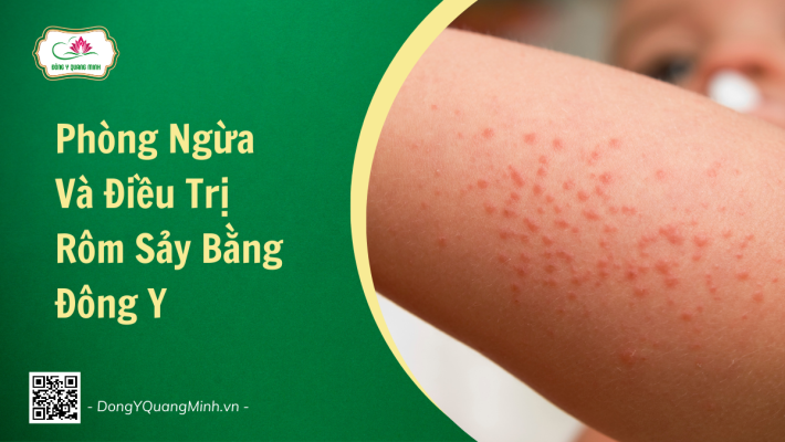 Phòng Ngừa Và Điều Trị Rôm Sảy Bằng Đông Y