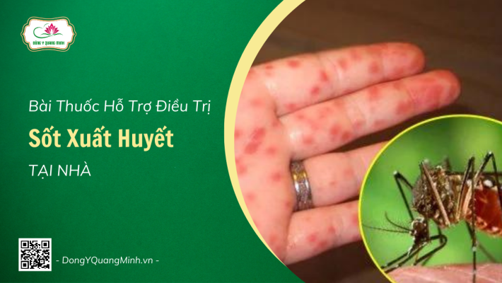 Bài Thuốc Hỗ Trợ Điều Trị Sốt Xuất Huyết Tại Nhà