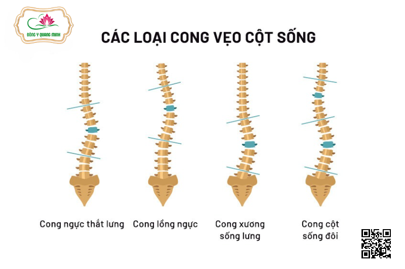 phân loại vẹo cột sống