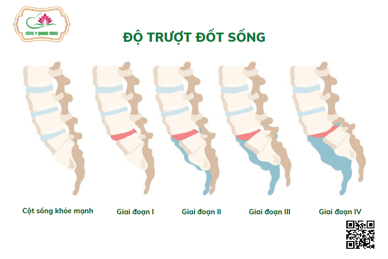 Phân độ trượt đốt sống
