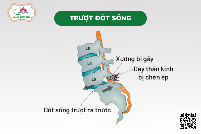 Trượt Đốt Sống: Nguyên Nhân, Phân Độ Và Dấu Hiệu