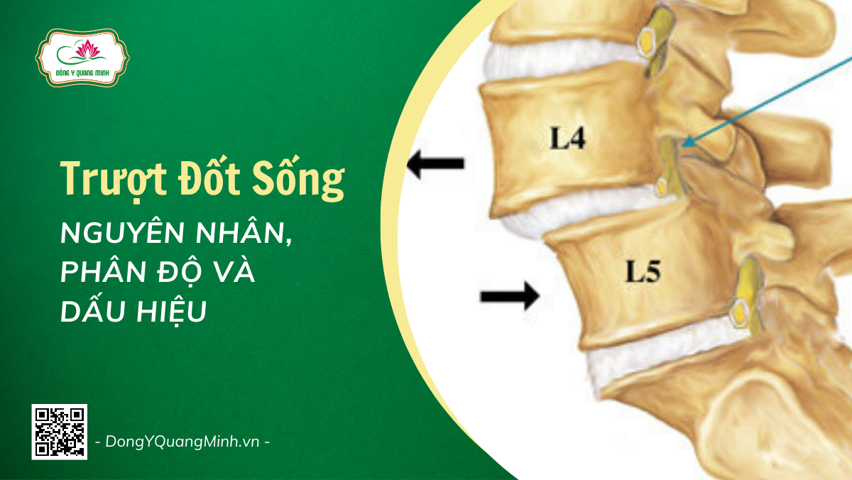 Trượt Đốt Sống: Nguyên Nhân, Phân Độ Và Dấu Hiệu