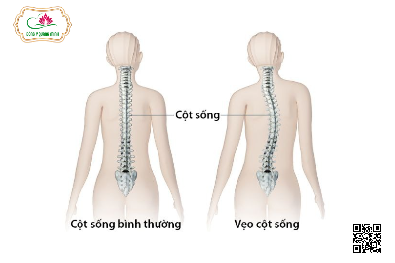 Cong Vẹo Cột Sống
