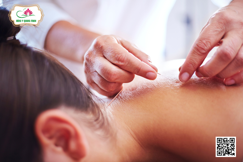 Điều Trị Đau Cổ Vai Gáy Ở Dân Văn Phòng Bằng Y Học Cổ Truyền